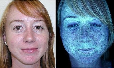 Skin analysis